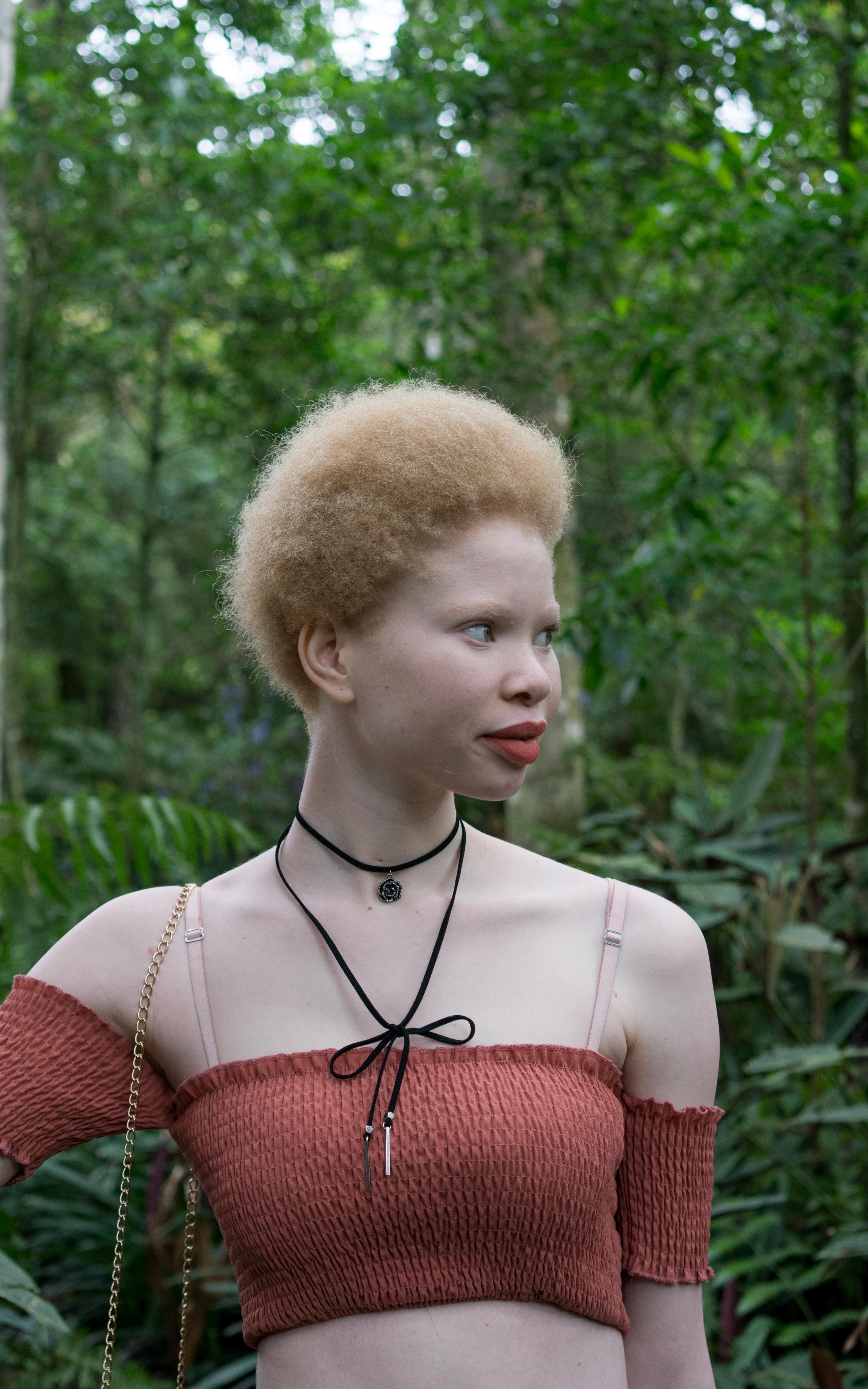 “What makes you different makes you beautiful.” Watch how this woman with albinism overcame online bullying