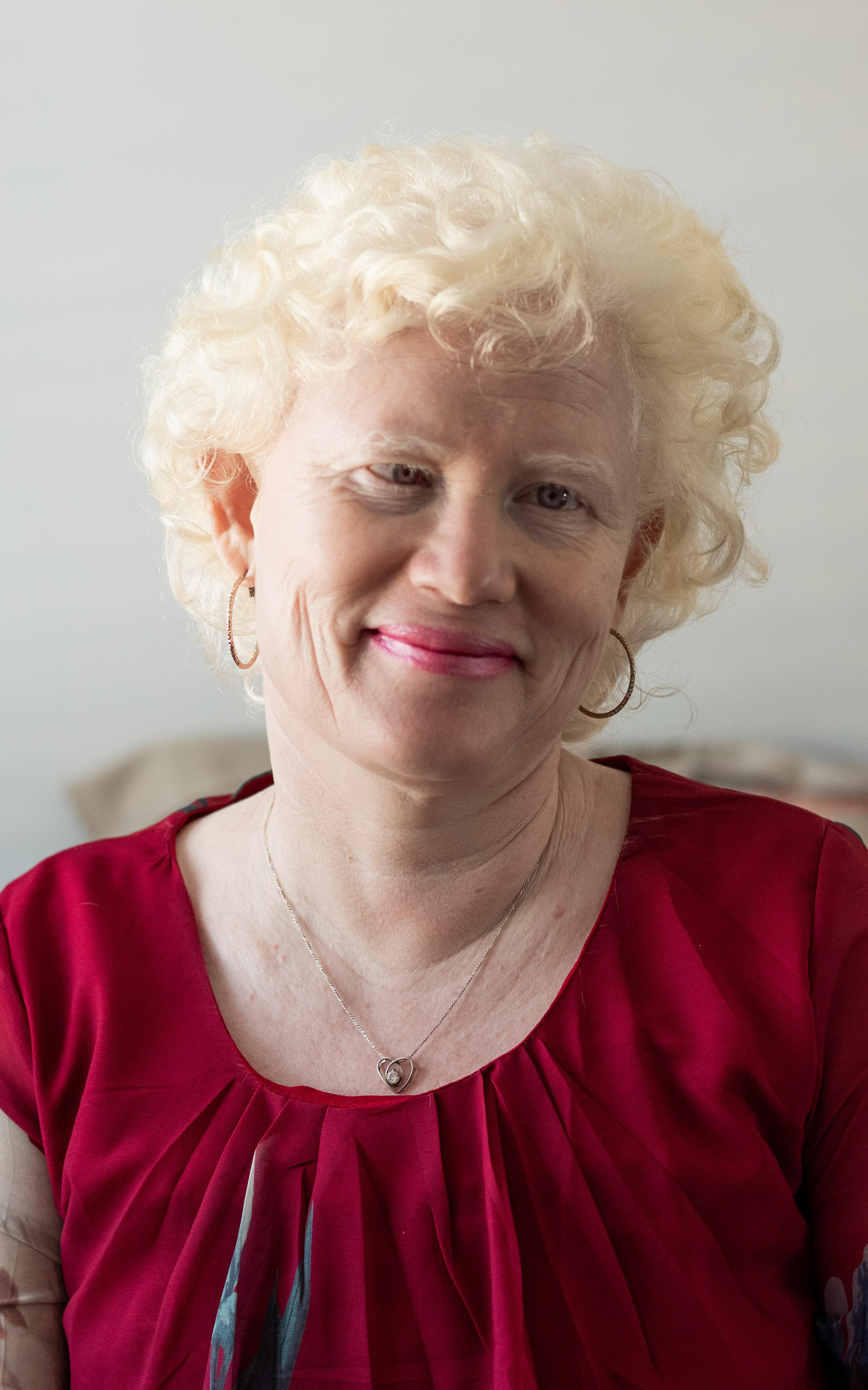 negative perceptions of albinism led her to be able to help youth with disabilities to gain confidence.