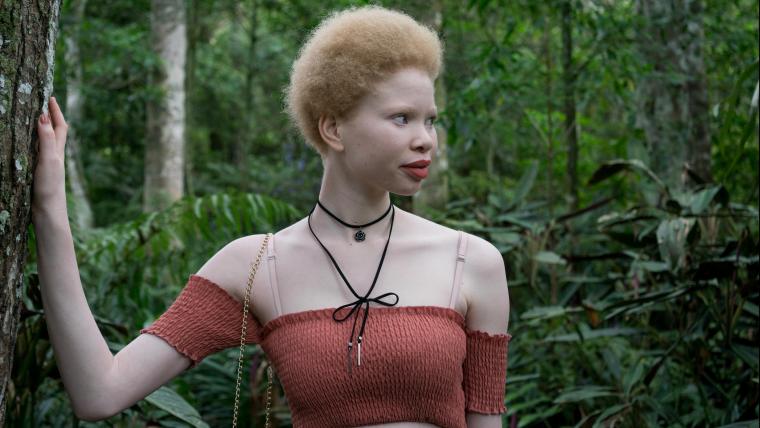 “What makes you different makes you beautiful.” Watch how this woman with albinism overcame online bullying